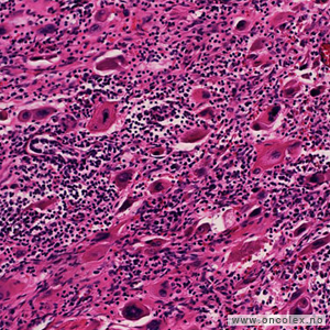Placenta-sitetumor på cellenivå.
