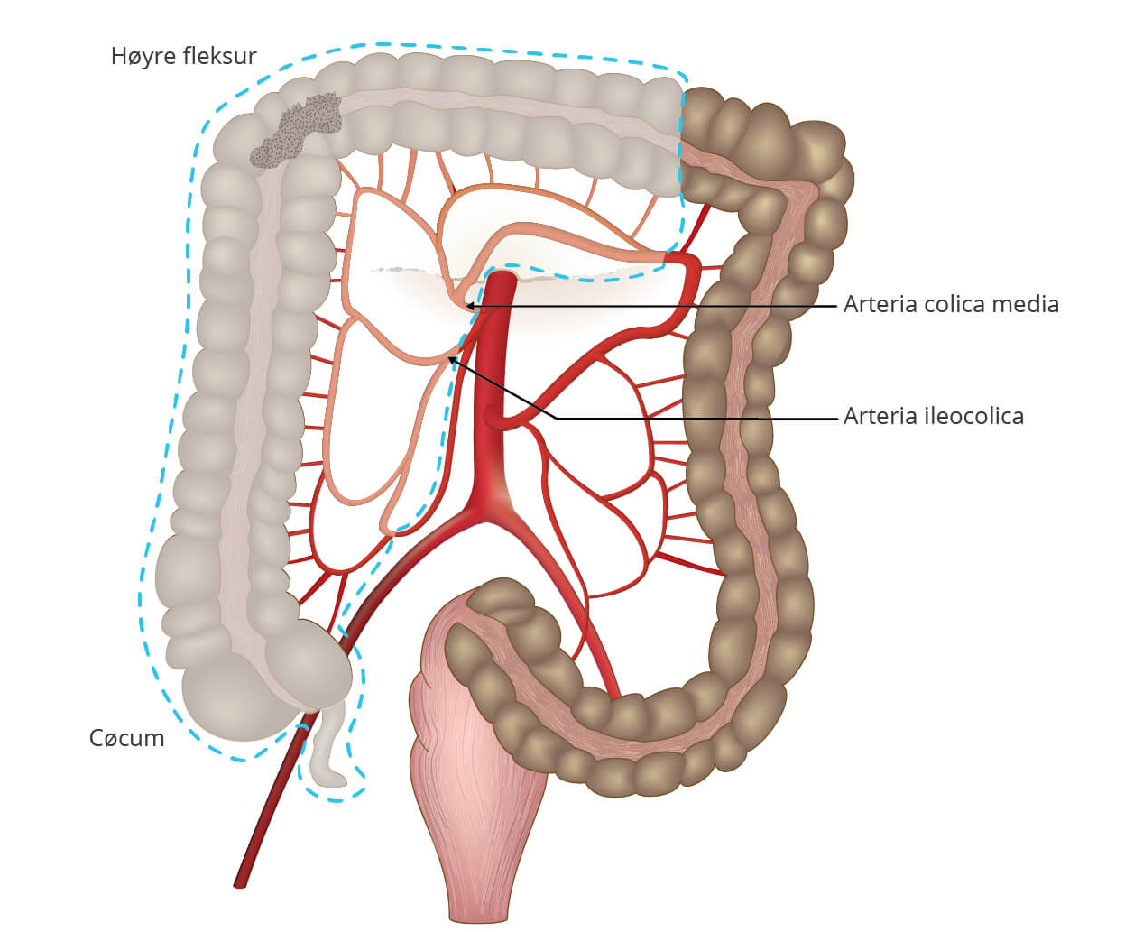 tykktarm_kirurgi_utvidet_hemikolektomi
