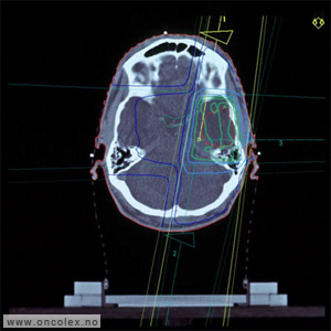Strålefelt og isodosekurver img hjernekreft