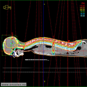 Strålefelt og isodosekurver img hele sentralnervesystemet
