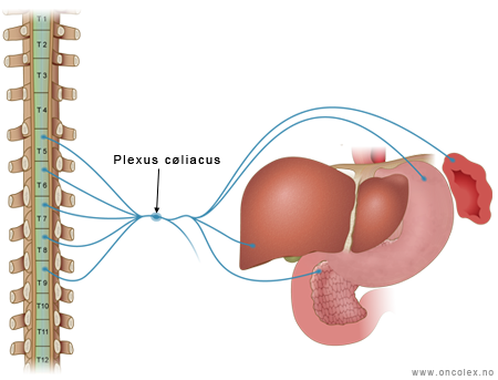 Illustrasjon Plexus cøliacus-nevrolyse