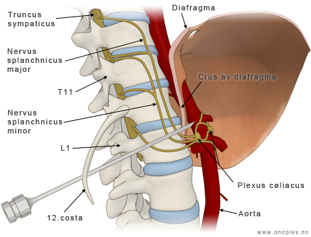 Illustrasjon Plexus cøliacus-nevrolyse