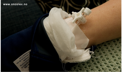 Bruk av kuldehansker og sokker ved kreftbehandling