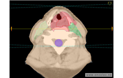 MR-bilde, primær strålebehandling, kreft i svelget.
