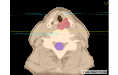 MR-bilde, primær strålebehandling, kreft i svelget.