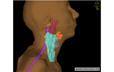 MR-bilde, primær strålebehandling, kreft i svelget.