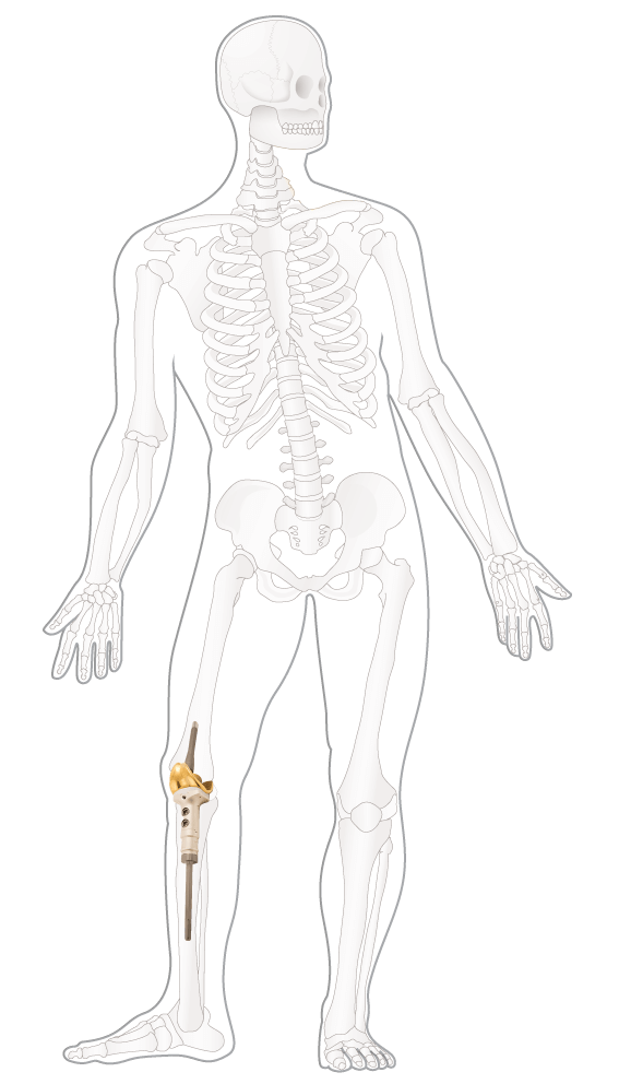 Kreftlex. Illustrasjon kneprotese, bensarkom.