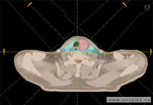 Eksempel snittbilde av strålefelt