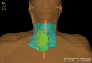 Eksempel på CT-bilder til doseplan
