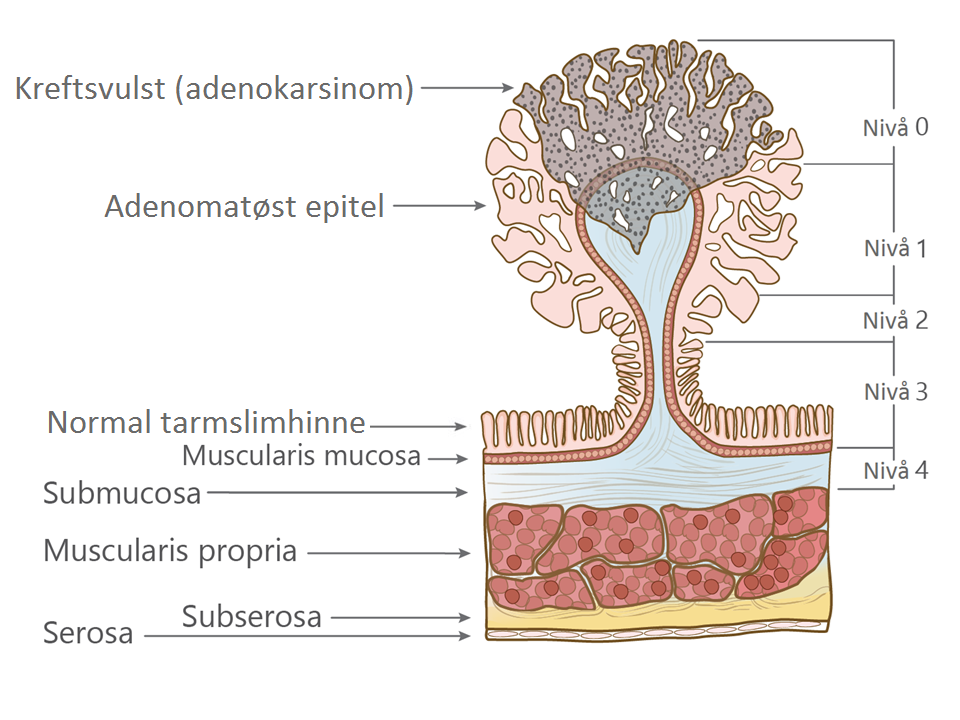 grag_overlevelse_meningeom