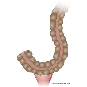 Illustrasjon, skjøting av tarm. Ende-side-skjøt.