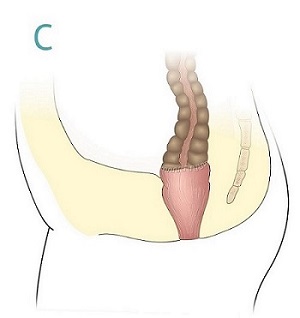 Endetarmskreft_endetarm og tykktarm sammenføyd med suturmaskin.
