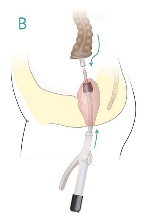 Endetarmskreft_ skjøting av tykktarm og endetarm med suturmaskin 