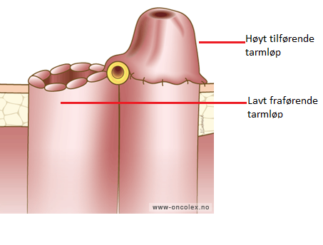 illustrasjon anleggelse av stomi