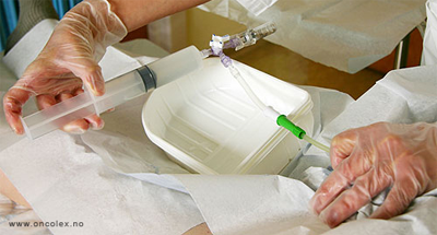 Foto, blæreskylling med BCG. 