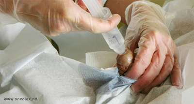 Foto, blæreskylling med BCG.