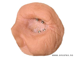 Foto, kreft i nese, bihuler. Implantat til øyeprotese.